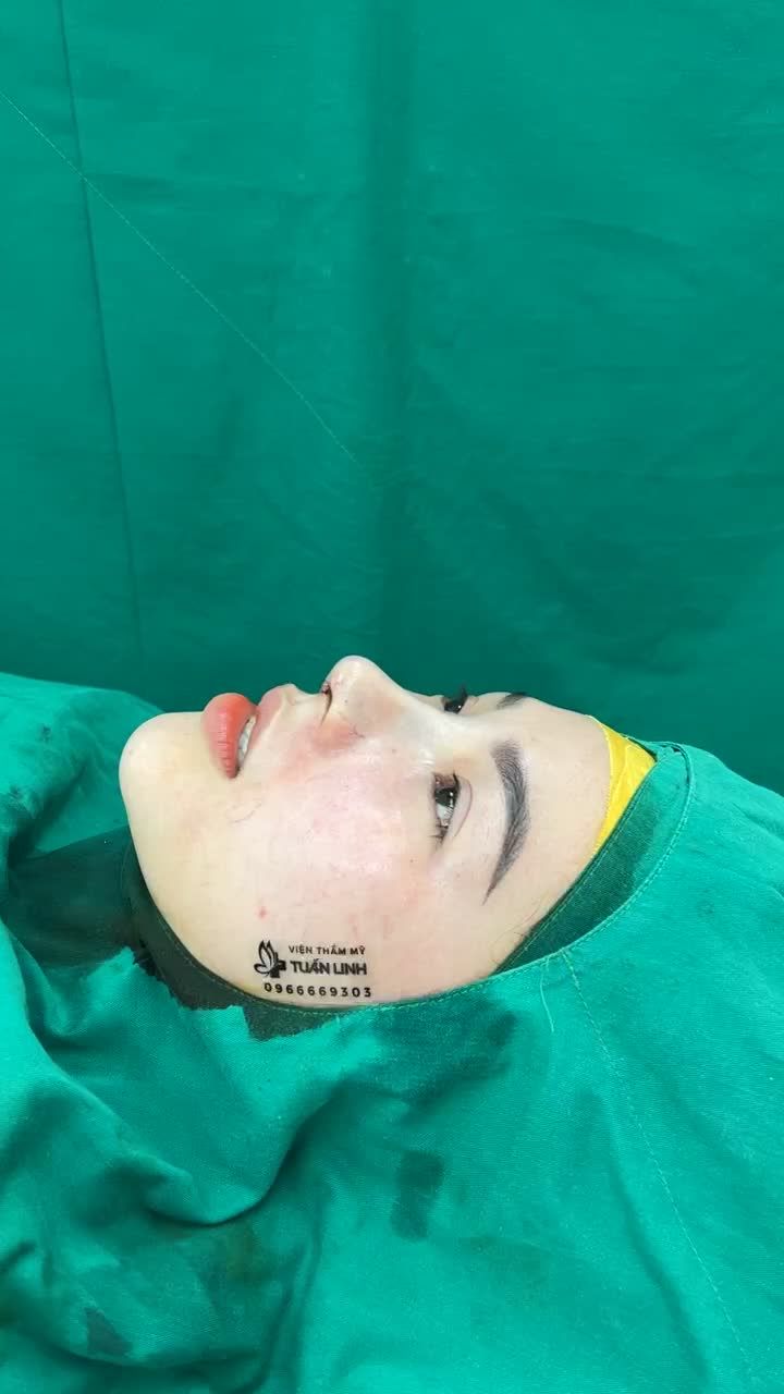 Case mũi cấu trúc surgiform vừa hoàn thành